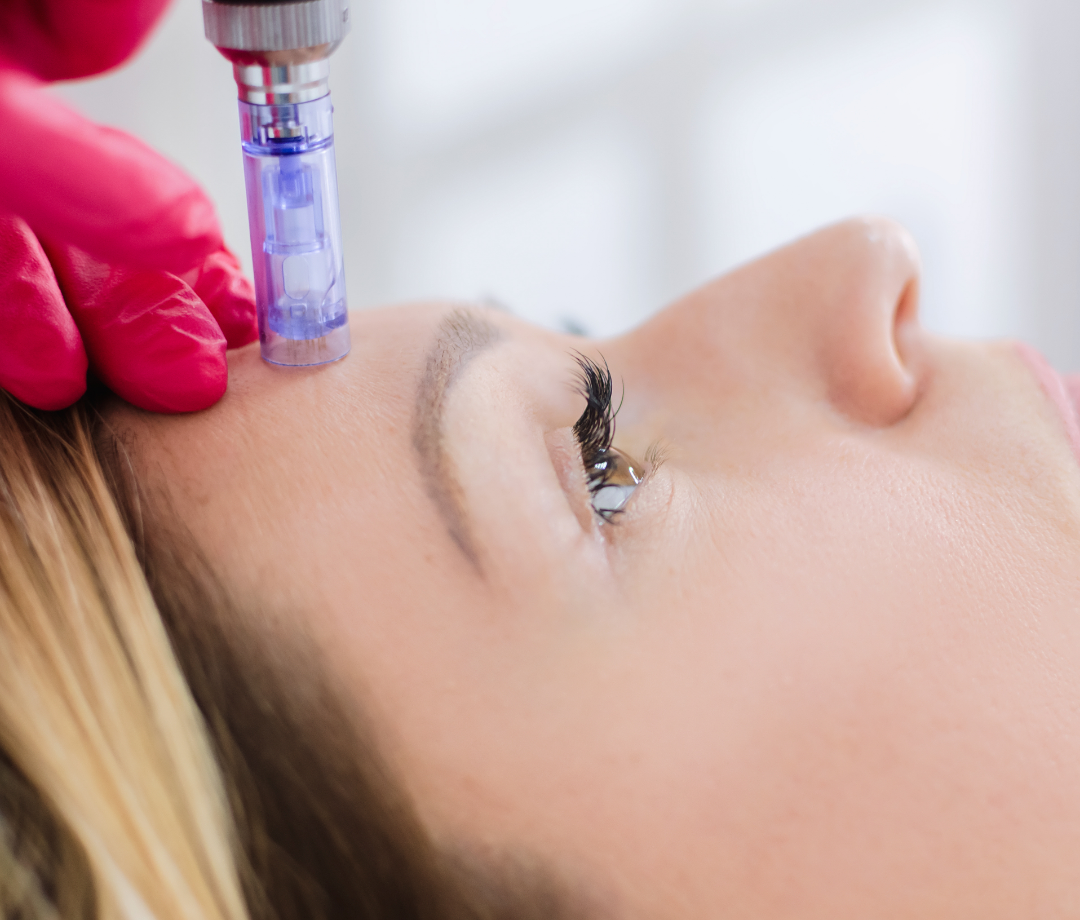 dermapen mezoterapia cienkoigłowa